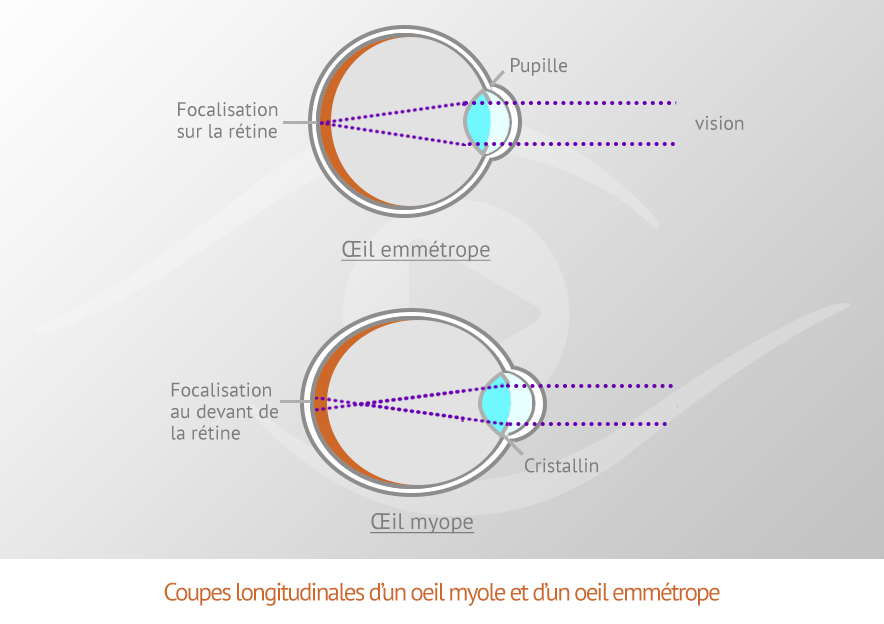 Coupe longitudinale d'un oeil myope et d'un un oeil emmétrope