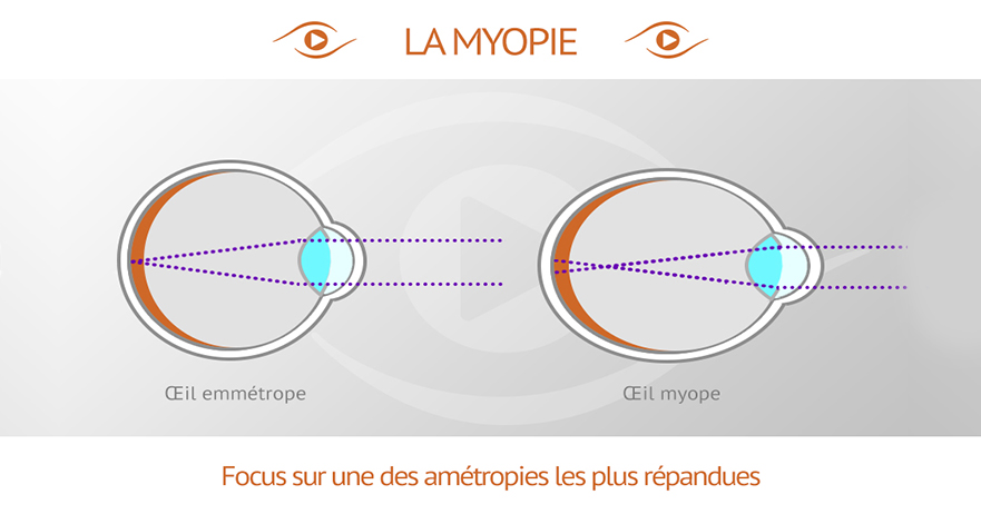Comparaison d'un oeil myope avec un oeil emmétrope