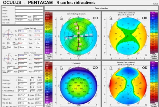 Bilan préopératoire : topographie cornéenne et mesure de la cornée