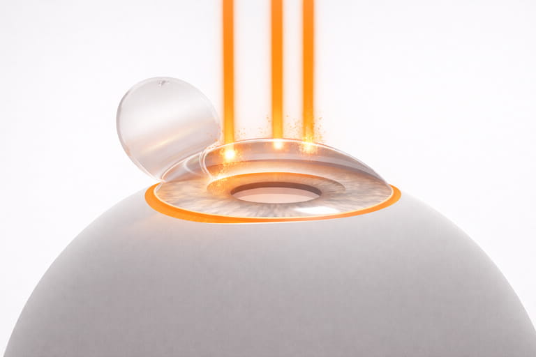 Schéma anatomique de l’œil humain montrant la cornée et la zone traitée par le laser excimer