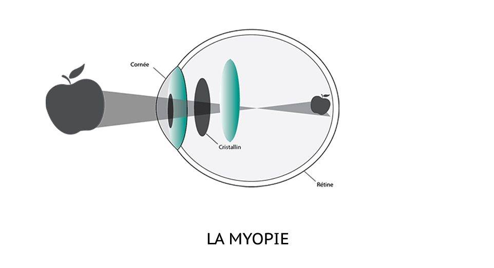 Schéma explicatif du fonctionnement de l'oeil myopie.