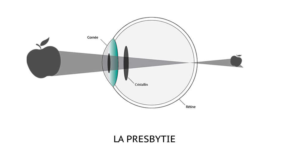 Schéma explicatif du fonctionnement de l'oeil presbyte.